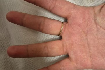 ירושלים: טבעת נתקעה באצבעה של אישה, מתנדב ידידים חילץ אותה מבלי לפצוע את האצבע • צפו🎥