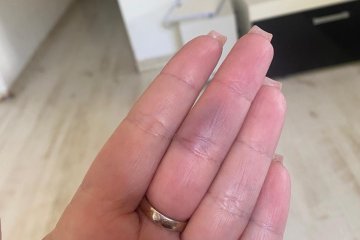 פסגת זאב: טבעת נתקעה באצבעה של אישה, מתנדב ידידים חילץ את הטבעת מן האצבע בשלום