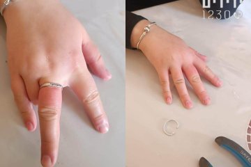 מודיעין עילית: טבעת של אישה נתקעה באצבעה – מתנדבי ידידים חילצו אותה בשלום