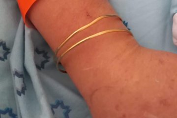 שערי צדק: זוג צמידים נתקע בידיה של מאושפזת, מתנדבי ידידים חילצו אותה בשלום