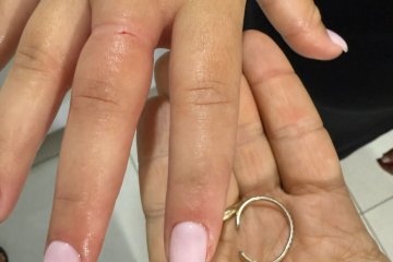 נתניה: שתי טבעות נתקעו באצבעה של אישה, מתנדב ידידים חילץ אותם בשלום