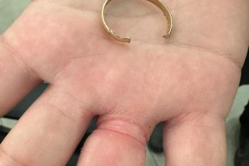 תלפיות: טבעת נתקעה באצבע של גבר, מתנדב ידידים חילץ את האצבע בשלום • “הפקחים ביקשו להצטרף לשורות הארגון” • צפו 🎥