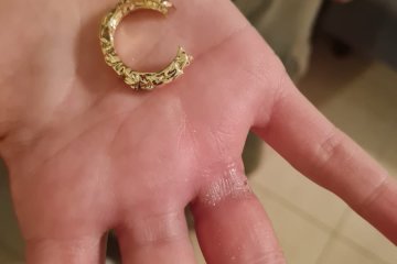 ראשון לציון: טבעת נתקעה על אצבע של נערה, מתנדב ידידים חילץ את האצבע בשלום