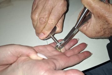 אשקלון: טבעת נתקעה באצבעה של אישה – מתנדב ידידים חילץ אותה בשלום • ״תודה לידידים על עבודת הקודש שהם עושים״