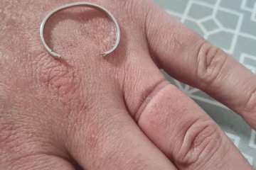 ראשון לציון: טבעת נתקעה באצבעו של גבר, סג”מ הסניף שחרר אותה בשלום