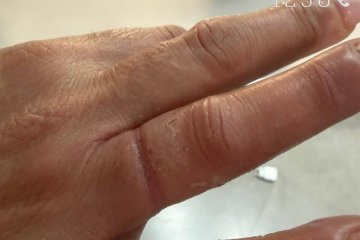 אשקלון: טבעת נתקעה באצבעה של אישה, מתנדבי ידידים חילצו את הטבעת מן האצבע בשלום