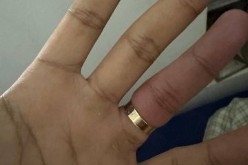 בית וגן: טבעת נתקעה באצבעה של גבר וחולצה בשלום ע”י מתנדב ידידים • צפו🎥