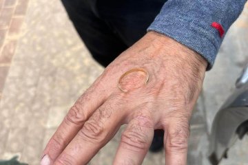נתניה: טבעת נתקעה על אצבעו של גבר – מתנדבי ידידים שחררו את הטבעת וחילצו את האצבע בשלום