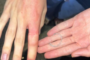 שבי ציון: טבעת של אישה נתקעה באצבעה, מתנדב ידידים חילץ אותה מן האצבע בשלום